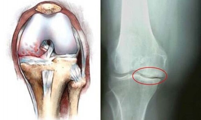arthrosis of the knee x-ray