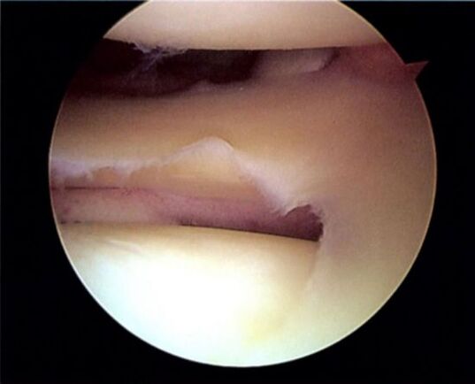 Torn meniscus leading to osteoarthritis of the knee