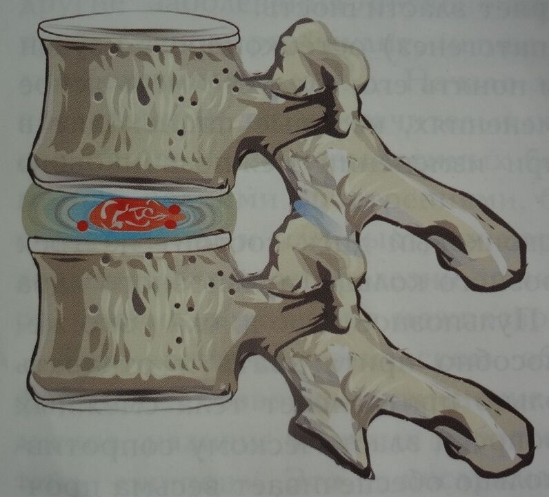 Damage to the nucleus pulposus of the intervertebral disc at the first stage of cervical osteochondrosis