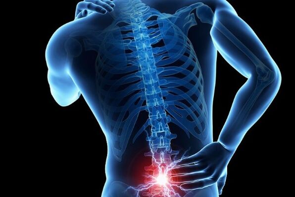 Acute lower back pain is a symptom of the displacement of the intervertebral discs