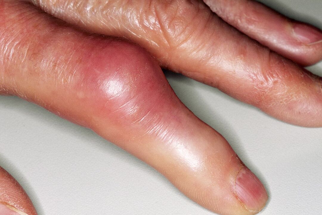 Swelling, deformation of the finger joint and acute pain after injury