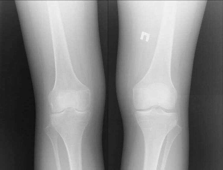 X-ray of knees affected by arthrosis