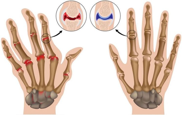 healthy hand joints and joints damaged by arthrosis