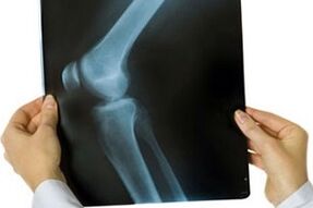 arthrosis of the knee joint on x-ray