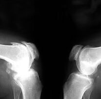 Arthrosis on x-ray